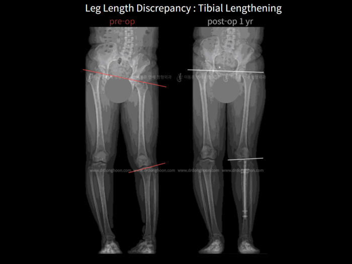 Tibial lengthening
