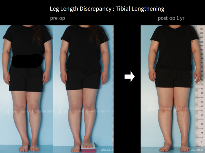 Tibial lengthening