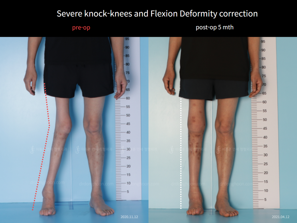 Severe knock-knees and Flexion Deformity correction : Congenital Condition