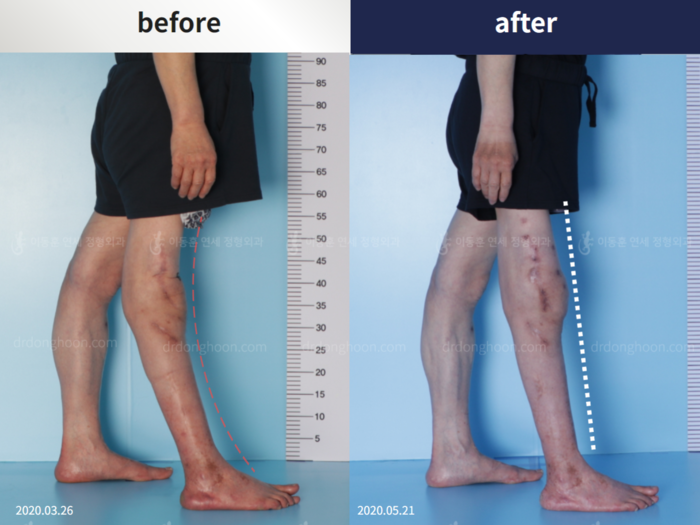 Complex & post-trauma deformity before and after radiograph example 3