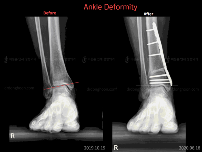 Foot & ankle deformity