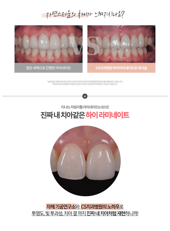 부산 서면 라미네이트 CS치과병원 부산 서면 라미네이트 Cs치과병원