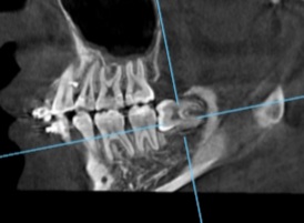 38CT sagittal