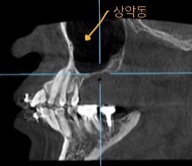 초진 CT