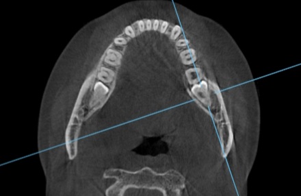 38CT axial