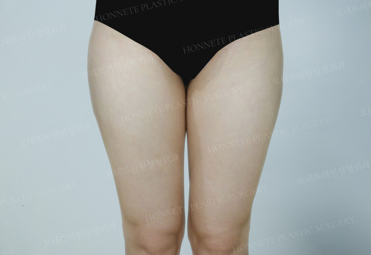 <p style="text-align:center">!<br><br>자세한 전후사진을 보려면 로그인 해주세요.</p>