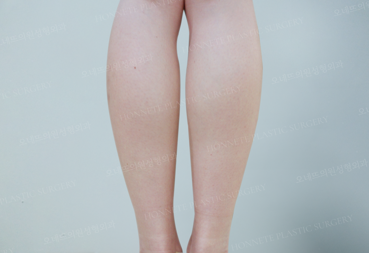 <p style="text-align:center">!<br><br>자세한 전후사진을 보려면 로그인 해주세요.</p>