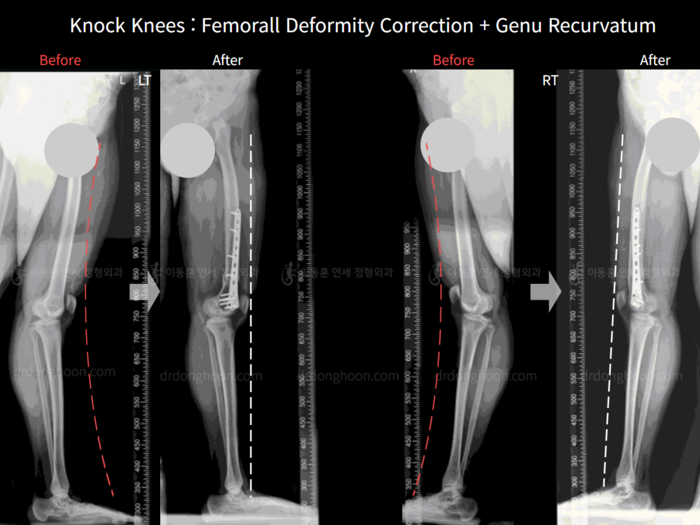 Femoral lengthening