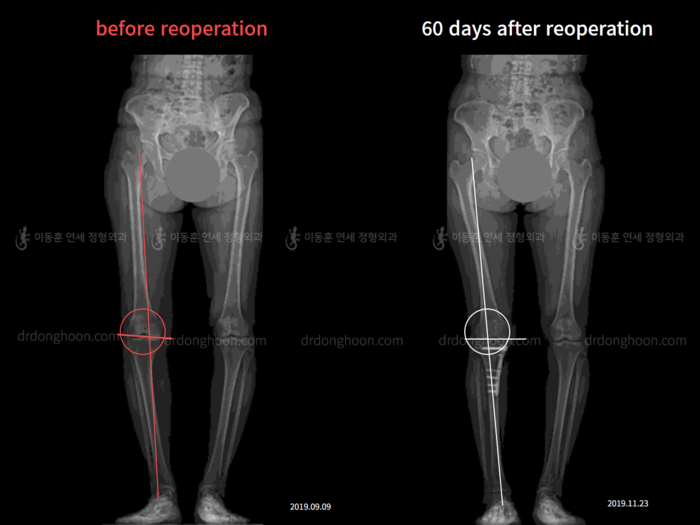 Reoperation after deformity correction