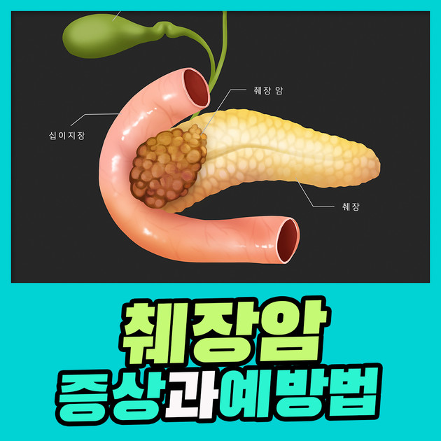 침묵의 암살자 췌장암 증상과 예방법 : 건강검진정보 침묵의 암살자 췌장암 증상과 예방법 : 건강검진정보