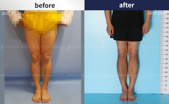 Tibial lengthening, 6 cm gained