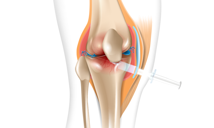 연골 재생 주사 부작용? 무릎 연골 재생을 효과적으로 관리하고 싶다면 3