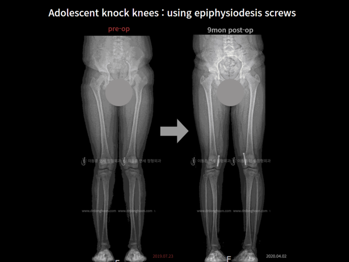 Bowlegs, knock knees & knee osteoarthritis before and after radiograph example 1