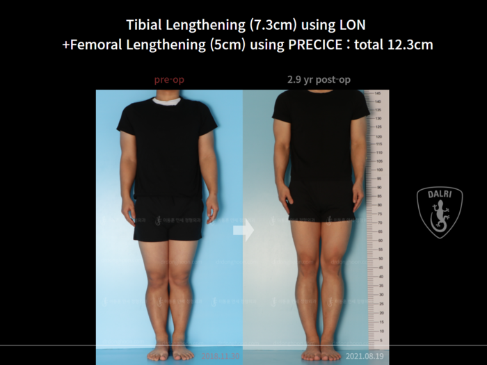 Femoral + tibial lengthening, 7.3 cm gained