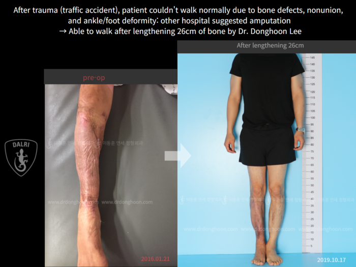 Post-trauma deformity