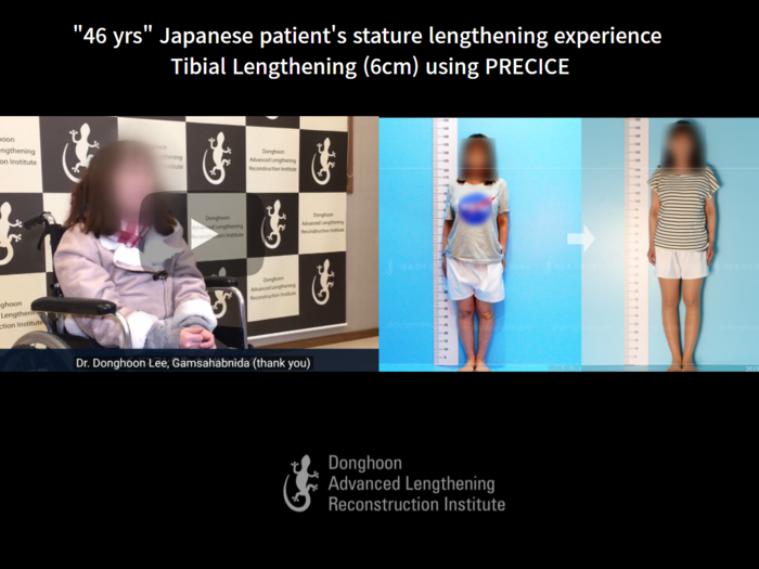 Tibial lengthening, 6.4 cm gained