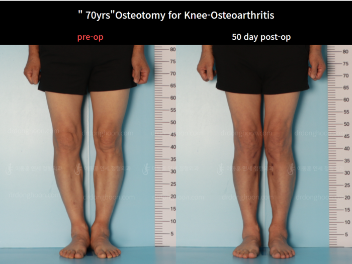 Osteotomy for knee osteoarthritis