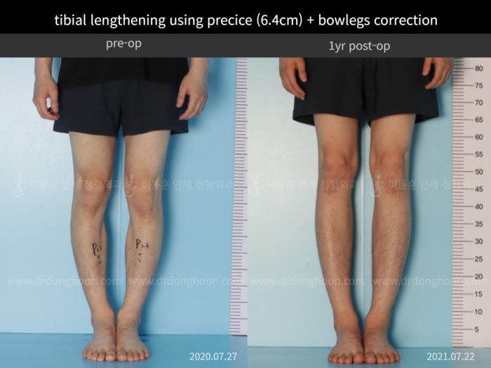 ยืดกระดูกหน้าแข้ง เพิ่มขึ้น 6.4 ซม.