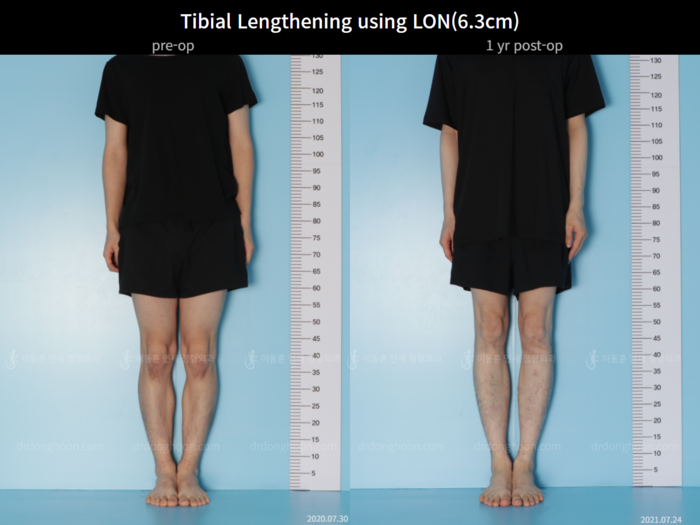 Tibial lengthening, 6.3 cm gained