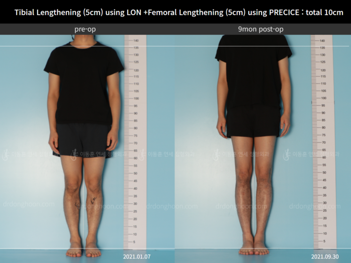 Femoral + tibial lengthening, 5 cm gained