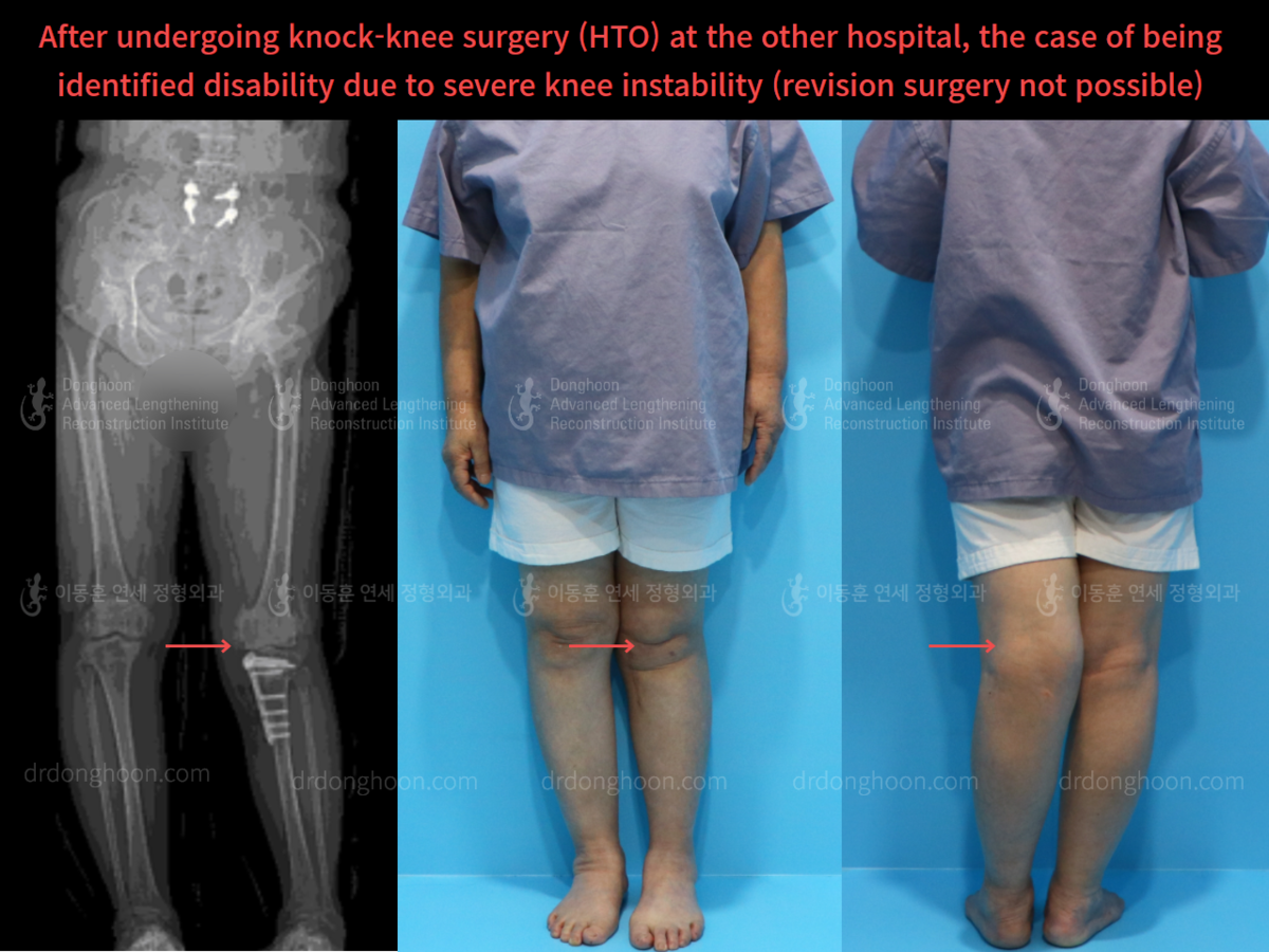 After undergoing knockknee surgery (HTO) at the other hospital, the
