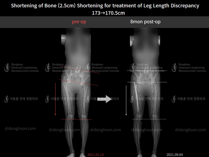Leg length discrepancy before and after radiograph example 2