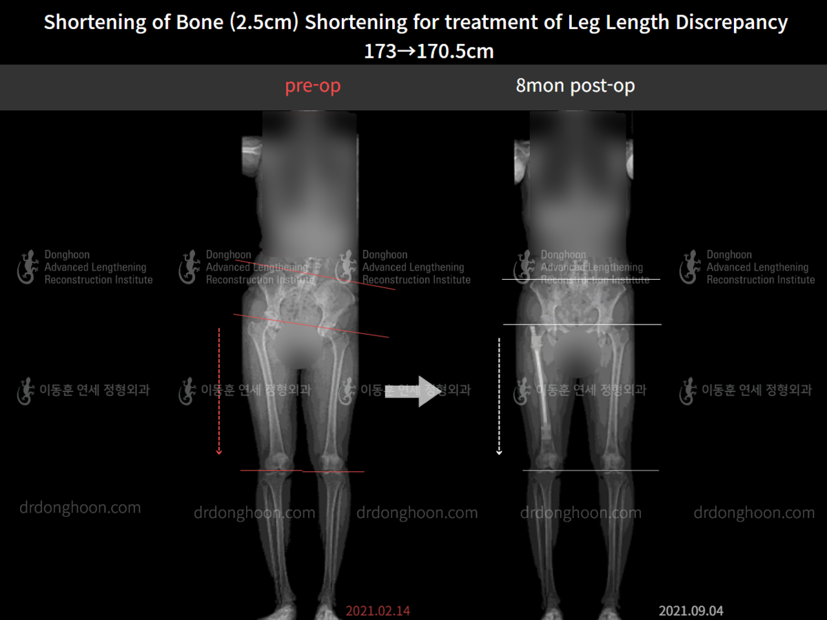 Shortening of Bone (2.5cm) Shortening for treatment of Leg Length ...