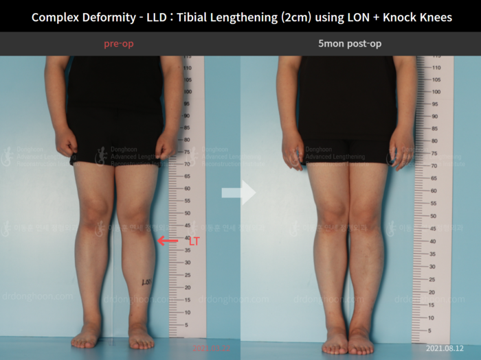 Tibial lengthening, 2 cm gained
