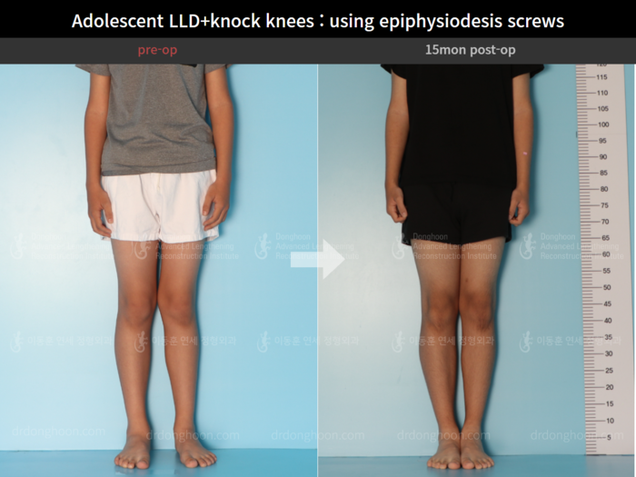 Paediatric & adolescent knock knees