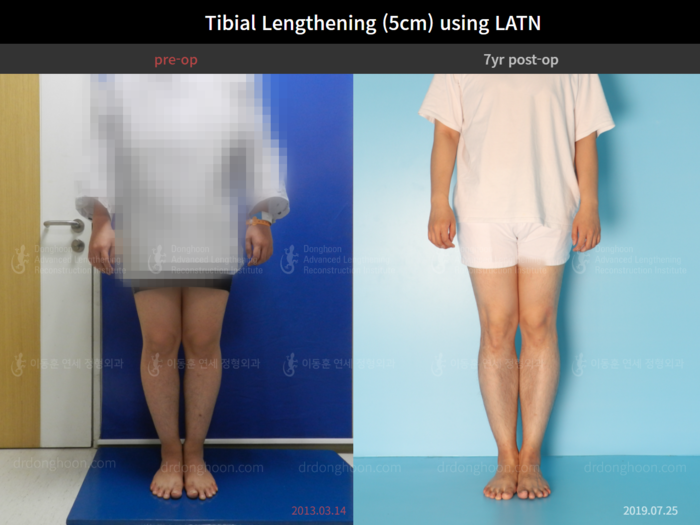 Tibial lengthening, 5 cm gained