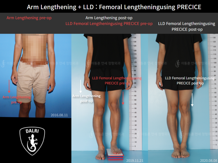 Femoral lengthening