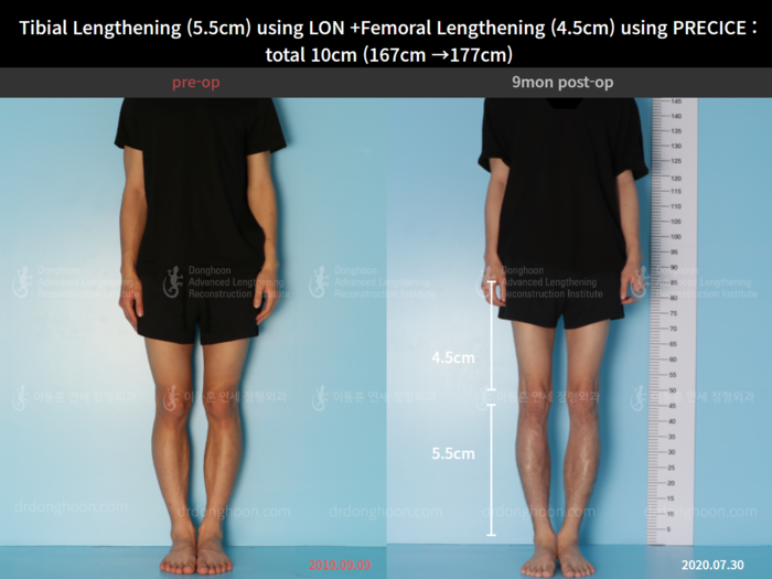 ยืดทั้งต้นขาและหน้าแข้ง เพิ่มขึ้น 5.5 ซม.
