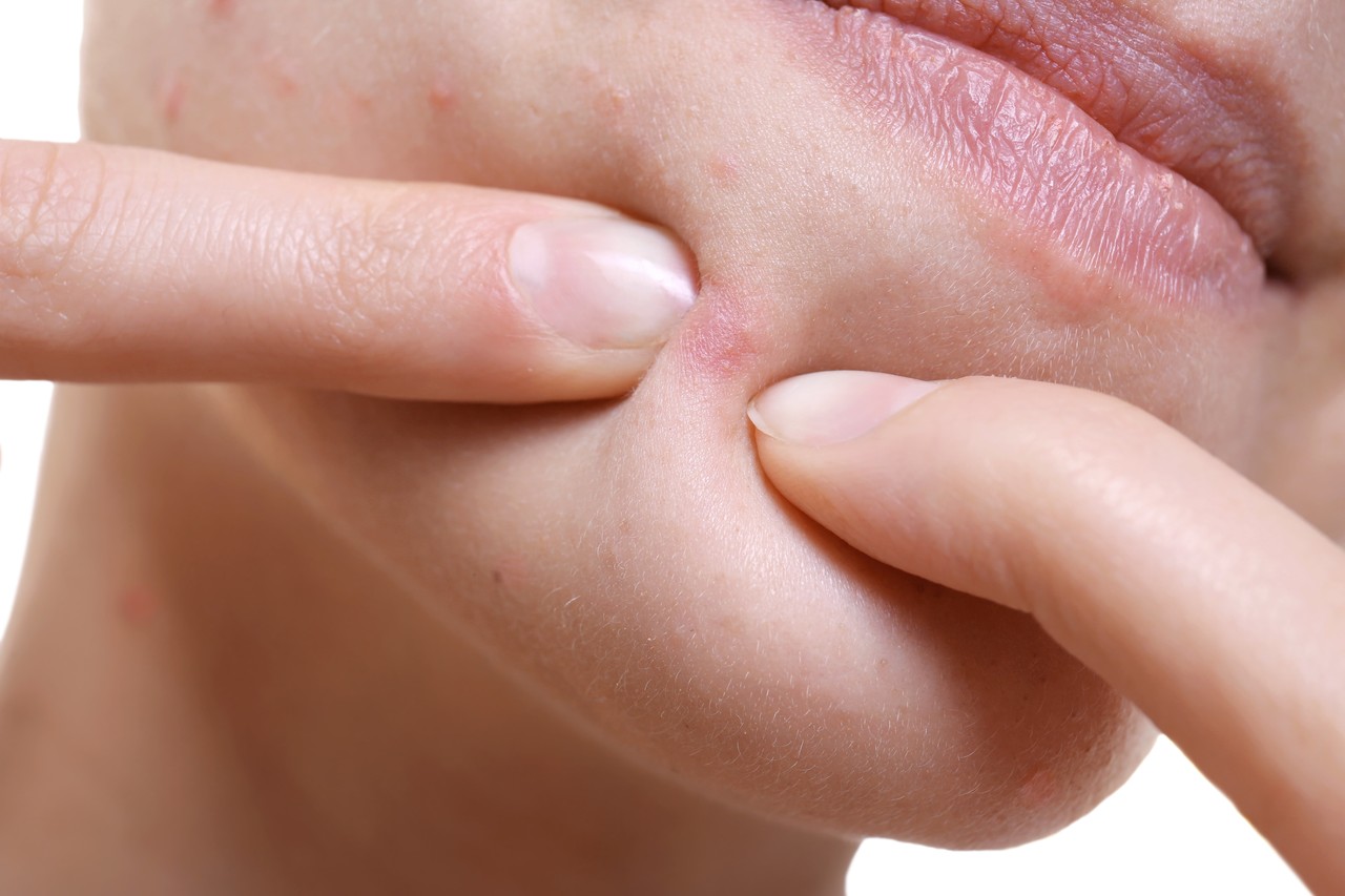 Acne Extrusion