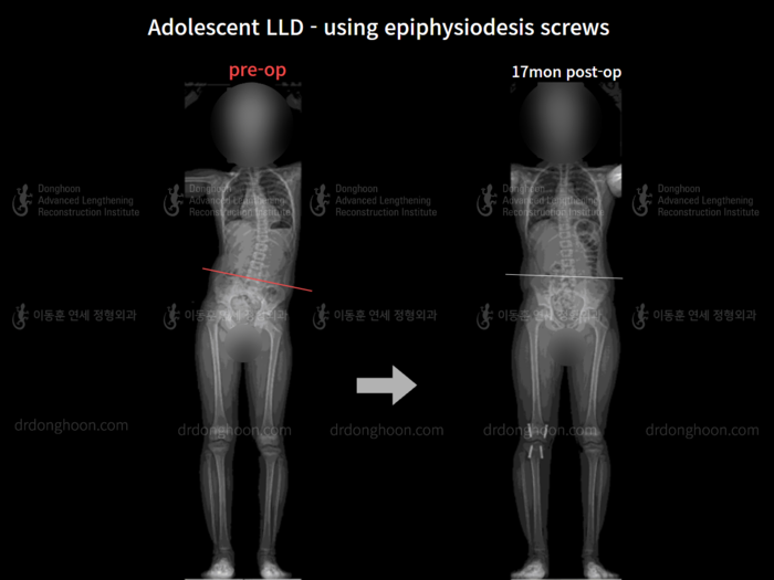 Paediatric & adolescent LLD