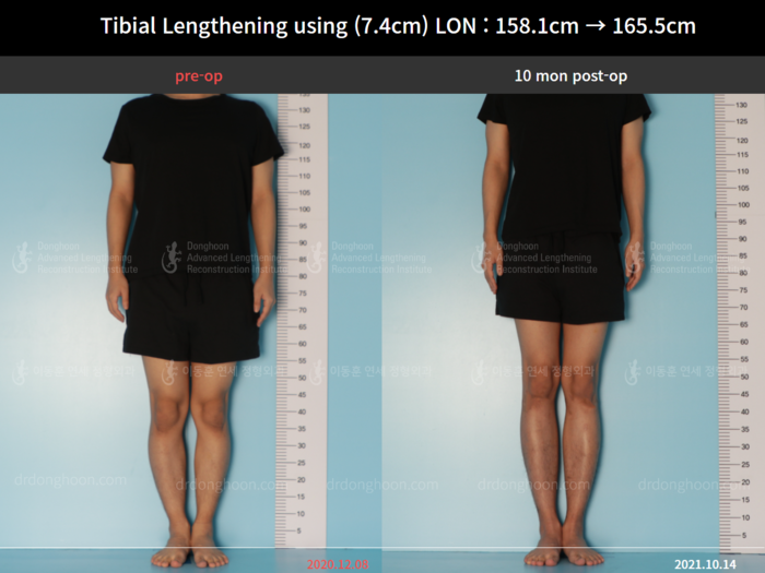 Tibial lengthening, 7.4 cm gained