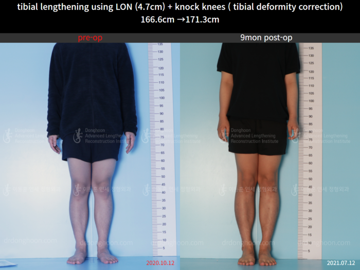 ยืดกระดูกหน้าแข้ง เพิ่มขึ้น 4.7 ซม.