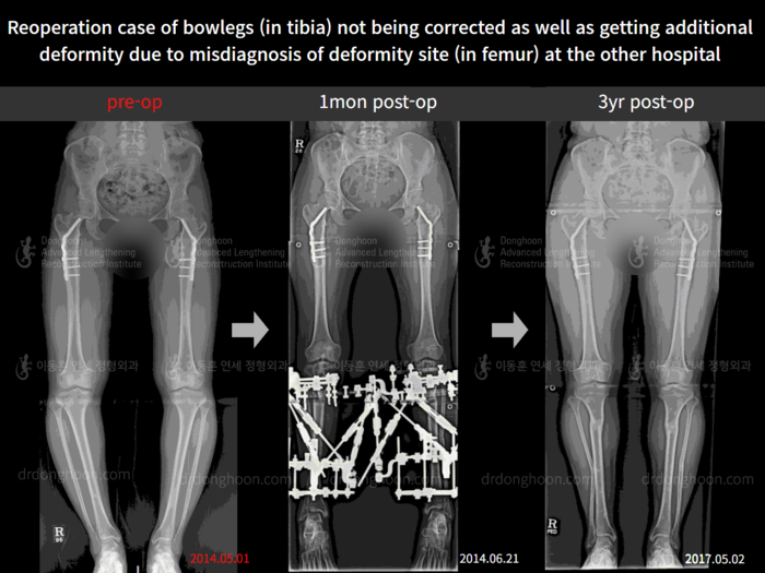 Femoral + tibial lengthening