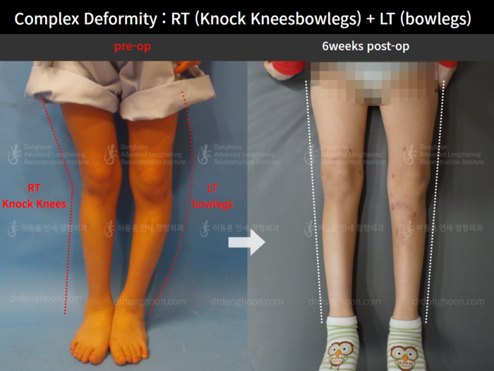 Paediatric & adolescent knock knees