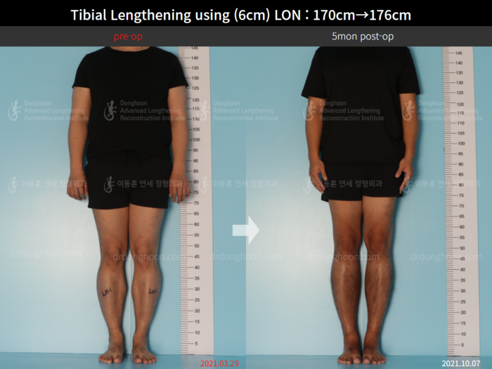 Tibial lengthening, 6 cm gained