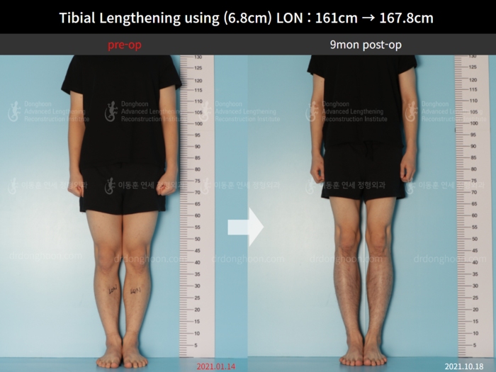 Tibial lengthening, 6.8 cm gained