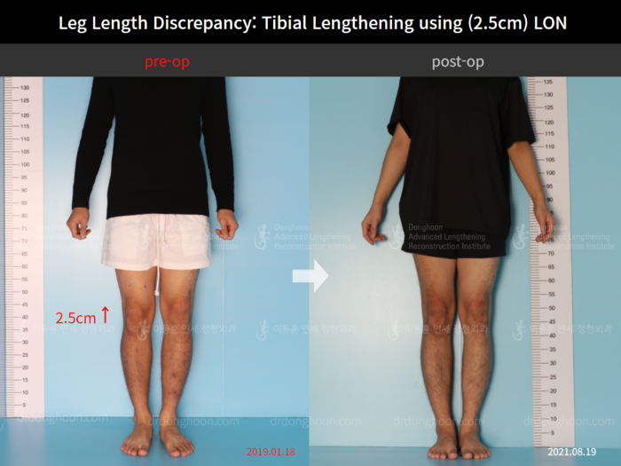 Tibial lengthening, 2.5 cm gained