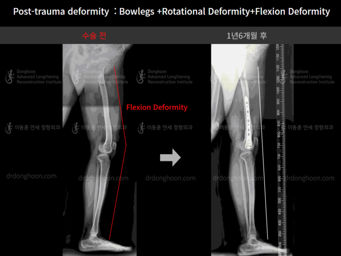 Flexion deformity