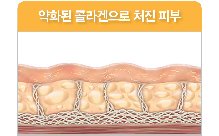 약화된 콜라겐으로 처진 피부
