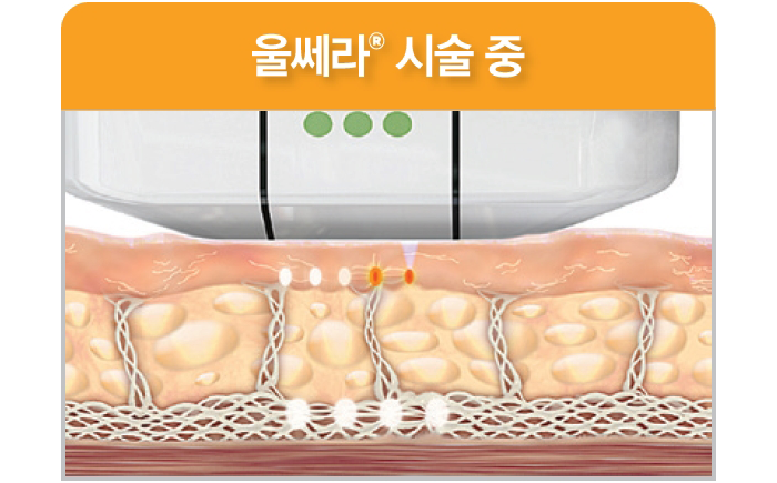 콜라겐 재생을 촉진