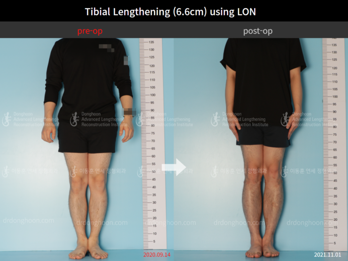 Tibial lengthening, 6.6 cm gained