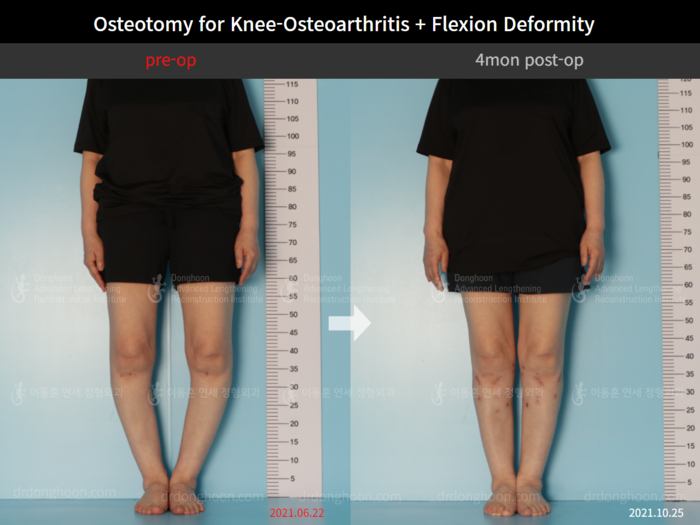 Osteotomy for knee osteoarthritis