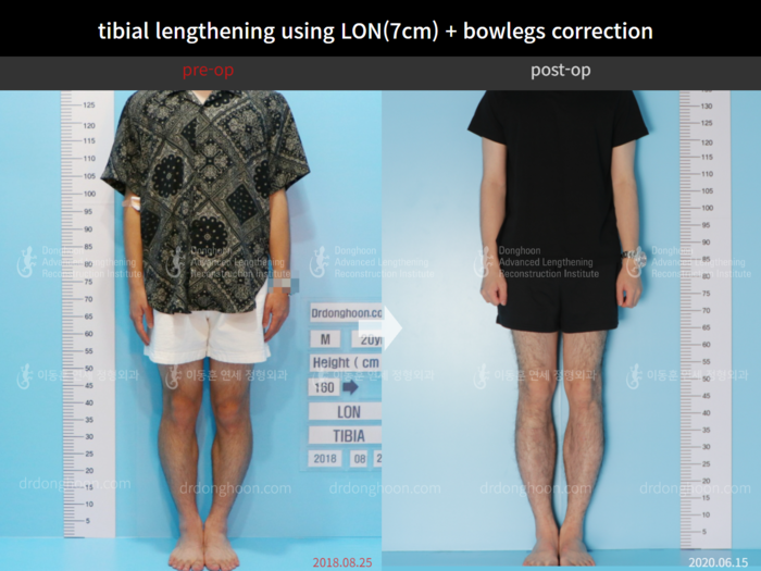 Tibial lengthening, 7 cm gained