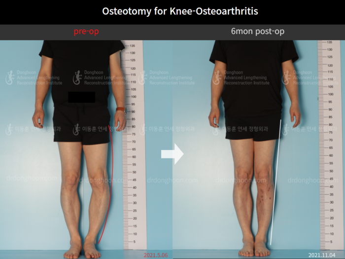 Osteotomy for knee osteoarthritis