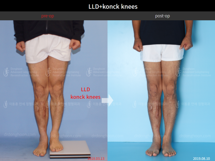 Adult LLD