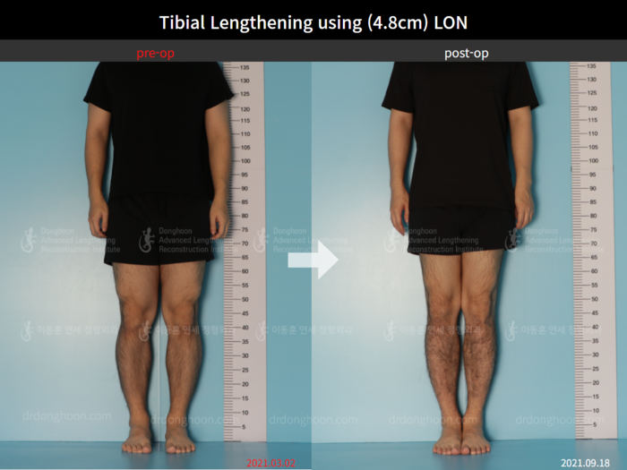 Tibial Lengthening using (4.8cm) LON